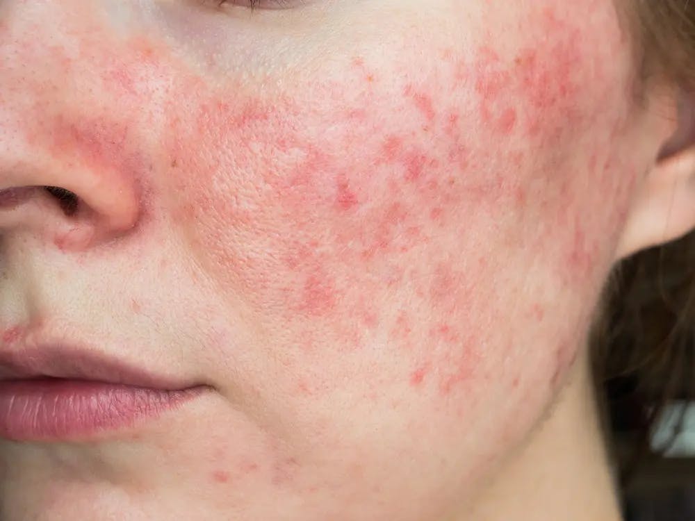 Cover Image for A woman with red spots on her cheek and nose