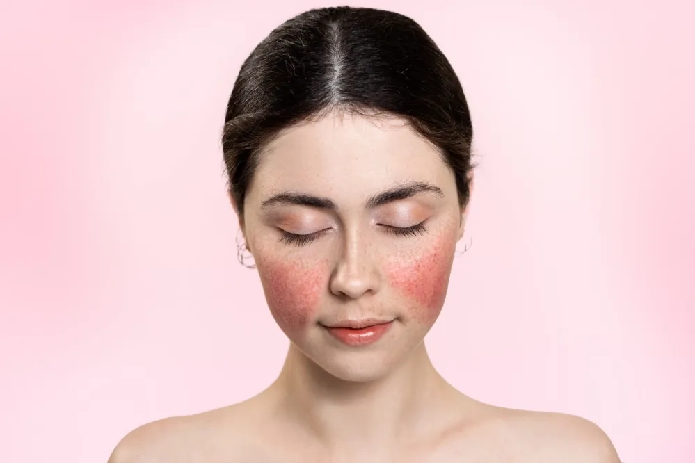 A woman with red, inflamed cheeks 