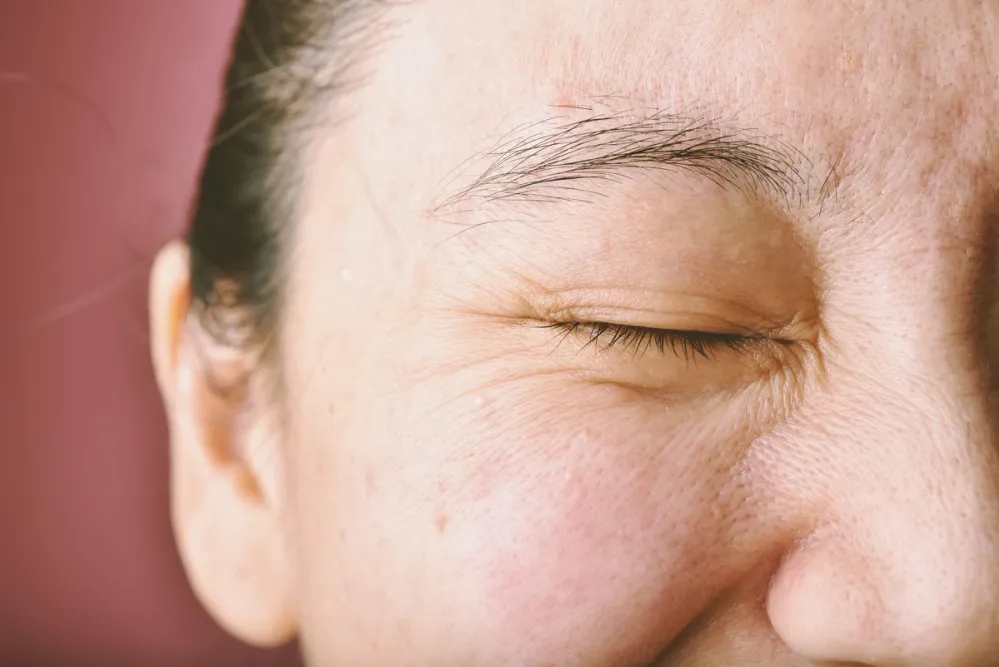 Woman with pigmentation, acne scaring, and some wrinkles