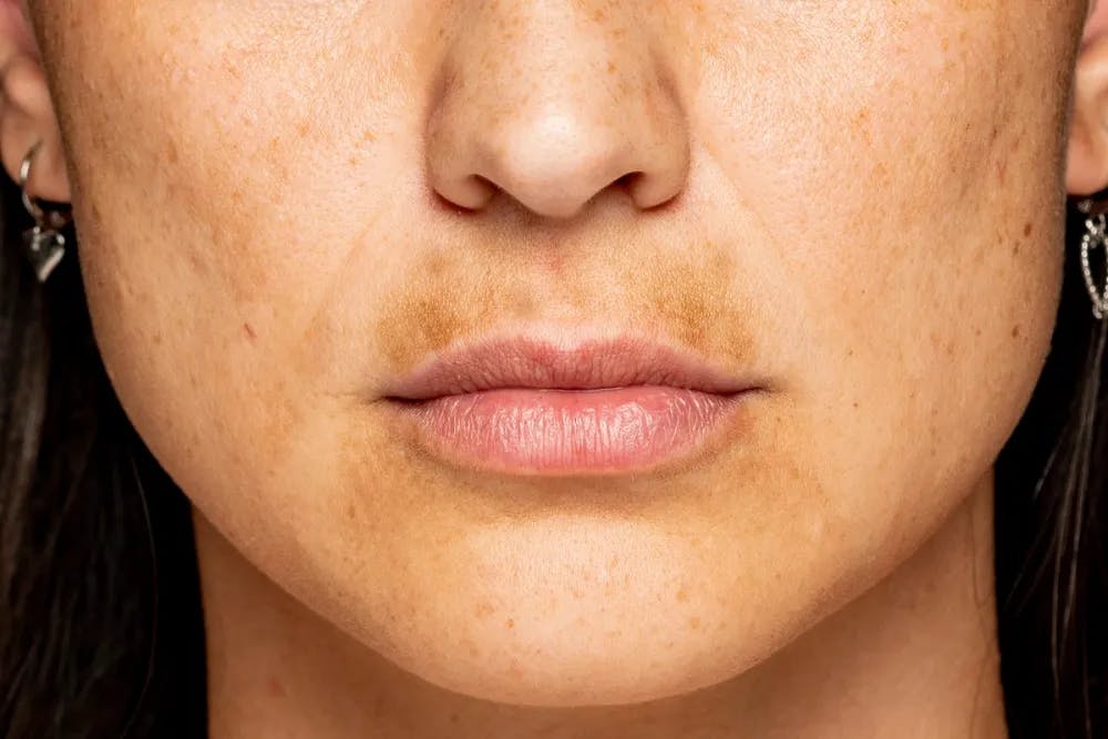Cover Image for A woman with dark spots around her mouth