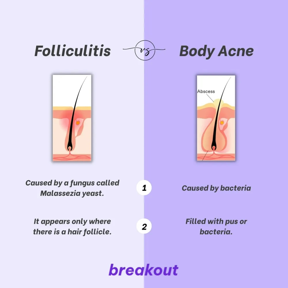 Diagram comparing Folliculitis and Body acne