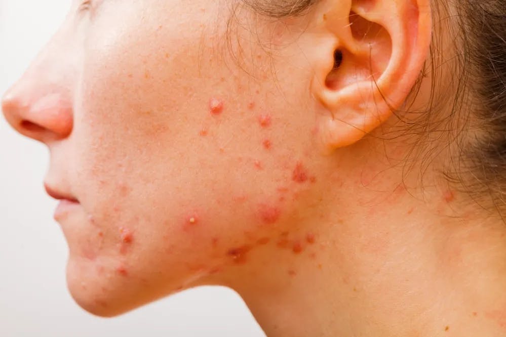 Cover Image for Red acne spot on woman's jawline